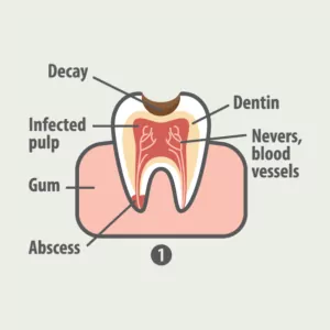 rootcanal-01