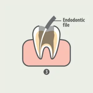 rootcanal-03