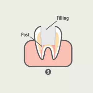 rootcanal-05